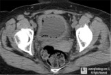 Emphysematous Cystitis